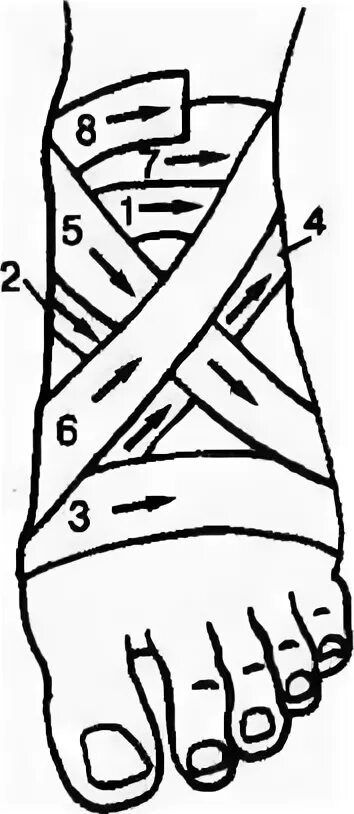 Техника наложения крестообразной повязки. Крестообразная повязка или восьмиобразная повязка. Восьмиобразная повязка на стопу алгоритм. Крестообразная повязка алгоритм. Восьмиобразная повязка на голеностопный.