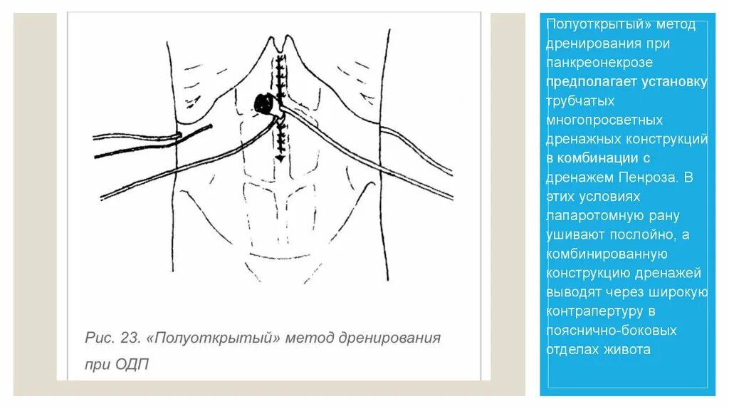 Методы дренирования при панкреонекрозе. Методы дренирующих операций при панкреонекрозе. Открытый метод дренирования при панкреонекрозе. Закрытое открытое и полуоткрытое дренирование. Операция при остром панкреатите