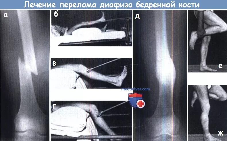 Сколько заживает бедро. Перелом диафиза бедренной кости операция. Перелом верхнего диафиза бедренной кости. Перелом диафиза бедренной кости гипс. Открытый перелом диафиза бедренной кости.