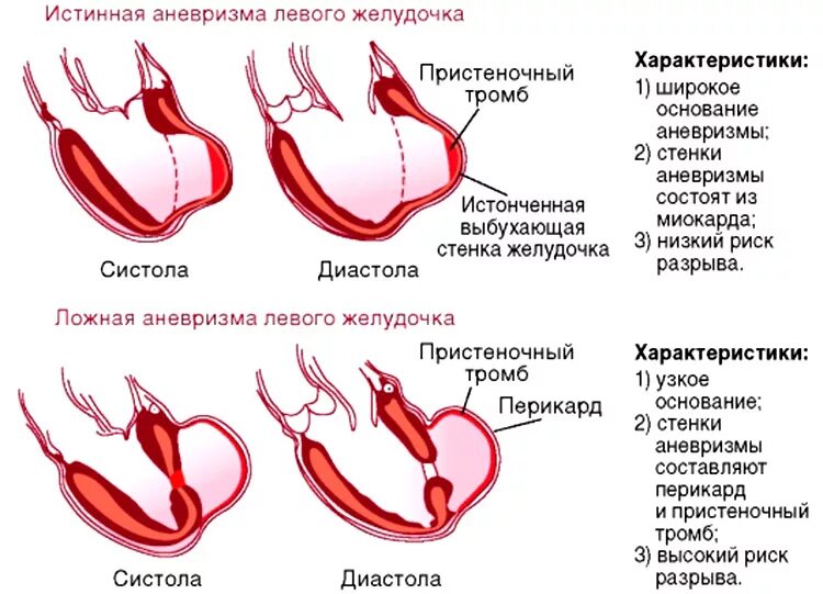 Осложнения острой аневризмы левого желудочка. Истинная аневризма левого желудочка. В диагностике постинфарктных аневризм левого желудочка. Плоская аневризма левого желудочка после инфаркта. Аневризма сердца что это такое симптомы