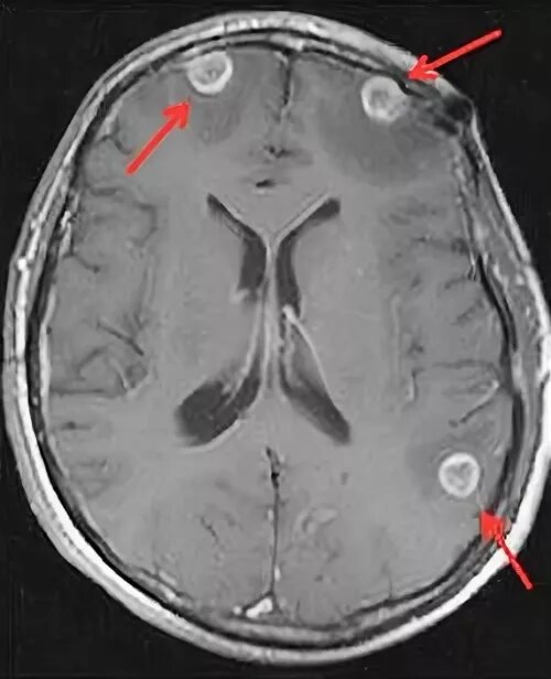 Туберкулез головного. Туберкулез мозговых оболочек мрт. Туберкулез мозговых оболочек кт.