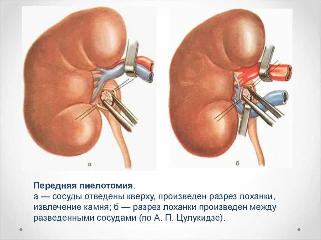 Собирается в почечную лоханку. Разрез при резекции почки.