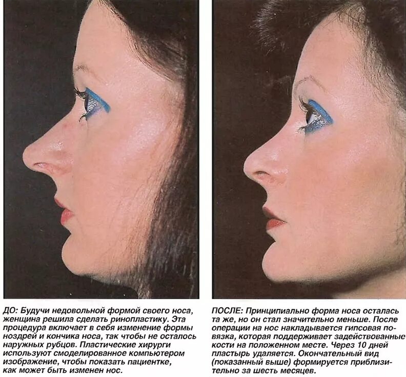 Формы носа ринопластика. Ринопластика до и после. Пластическая хирургия носа изменение формы. Ринопластика носа схема. Почему увеличивается нос