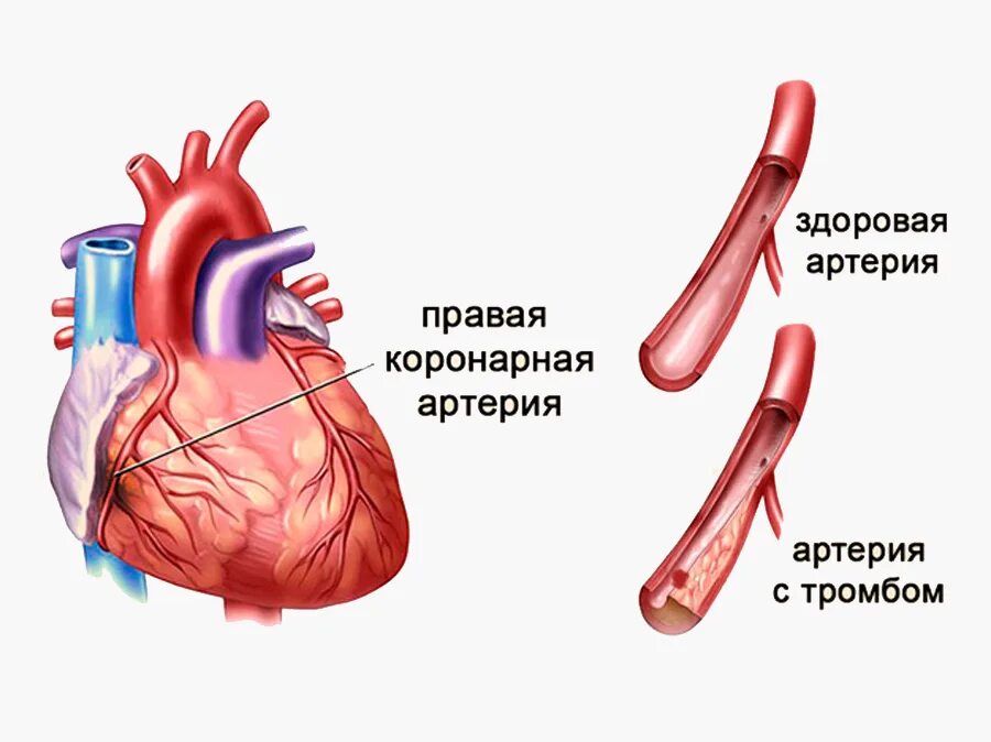 Обширный инфаркт что это такое простыми. Сердце при инфаркте миокарда. инфаркт миокарда рисунок.