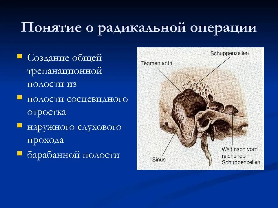 Полость после Радикальной операции на ухе. Радикальная санирующая операция на среднем ухе. Сосцевидная стенка барабанной полости. Радикальная полость среднего уха. Операция на среднем ухе