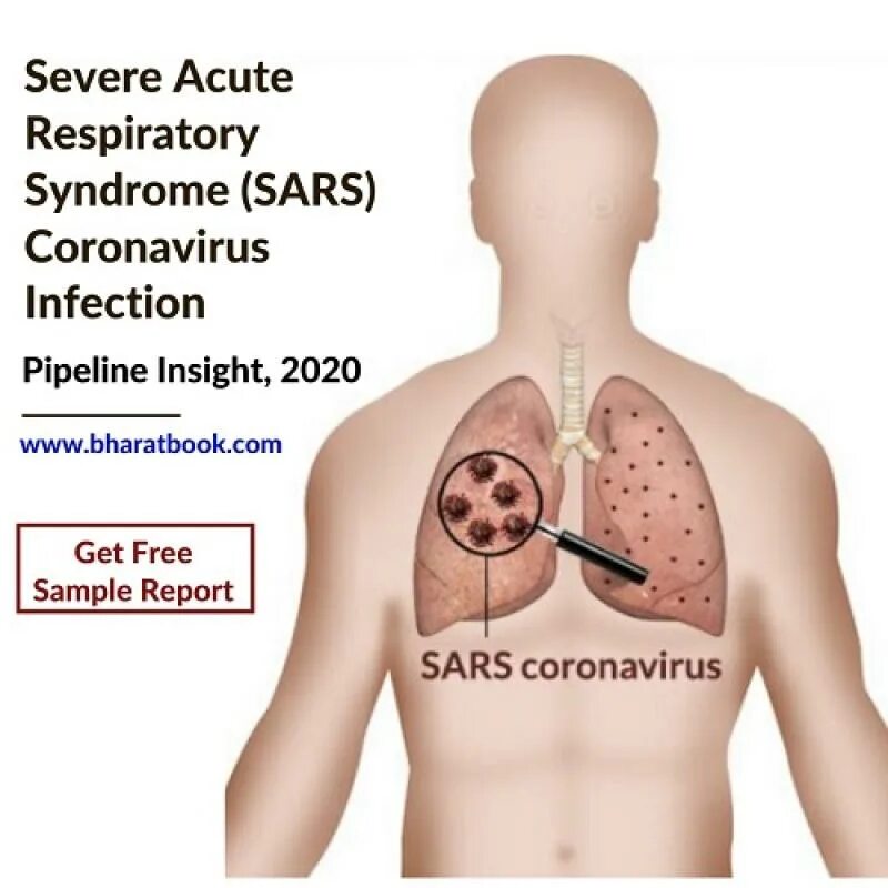 Severe acute