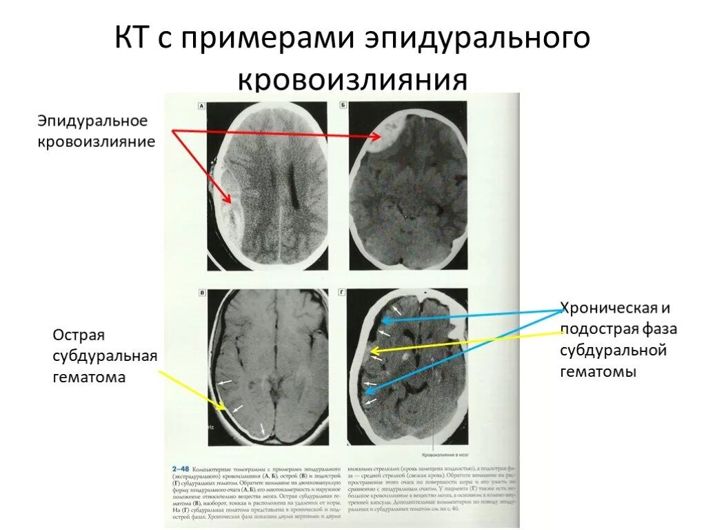 Кт эпидуральной и субдуральной гематомы. Подострая эпидуральная гематома на кт. Хроническая эпидуральная гематома кт. Субдуральная гематома головного мозга кт. Гематома в стадии организации