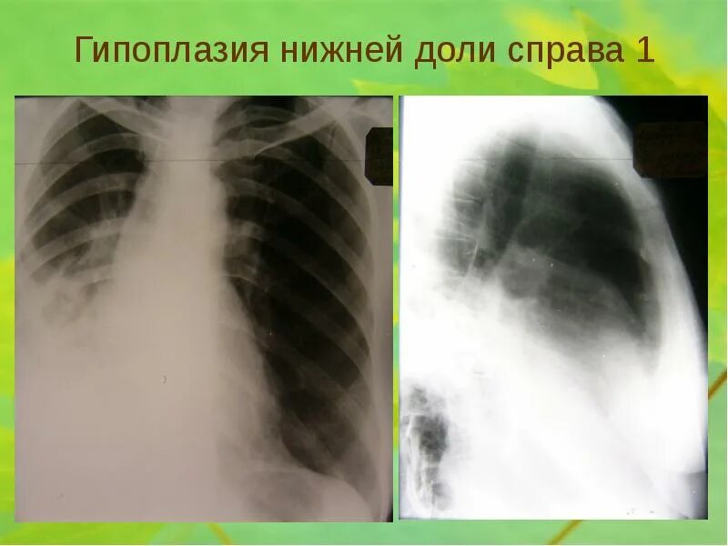 Гипоплазия 12 пары ребер. Простая гипоплазия легкого. кистозная гипоплазия легкого. гипоплазия доли легкого. кистозная гипоплазия легкого рентген.