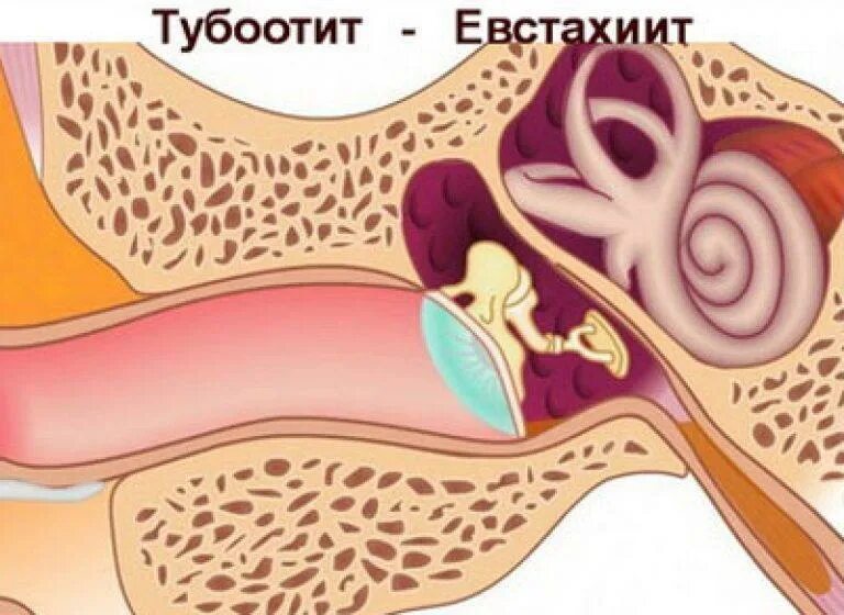 Заложенность уха тубоотит. Евстахиит барабанная перепонка. Катаральный отит евстахиит. Острый катаральный евстахиит.