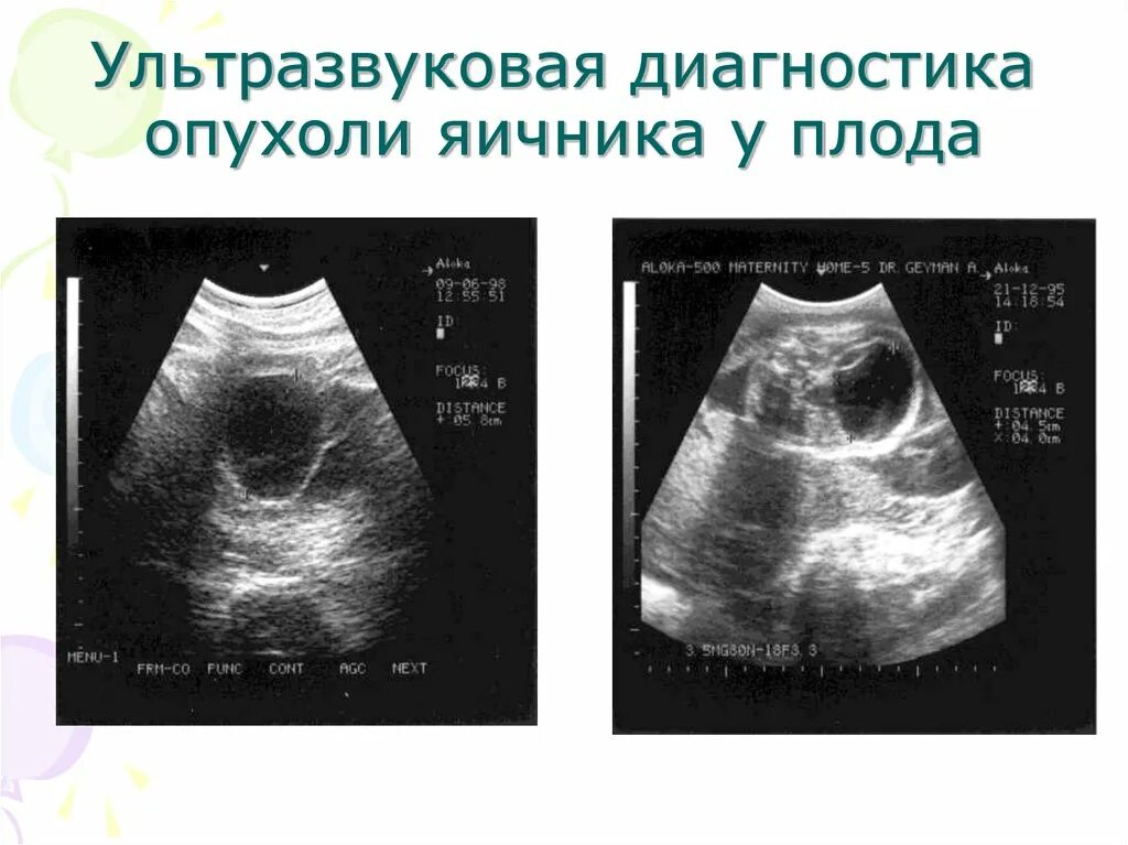 Объемные образования яичников. Объемное образование яичника. Диагностика опухолей яичников. Диагностика доброкачественных опухолей яичников. Доброкачественная опухоль яичника клинические