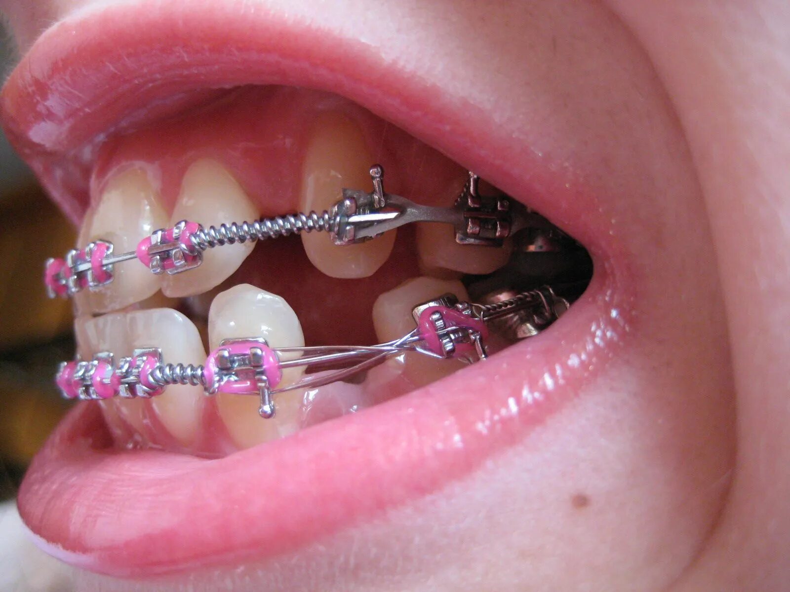 Matching brackets
