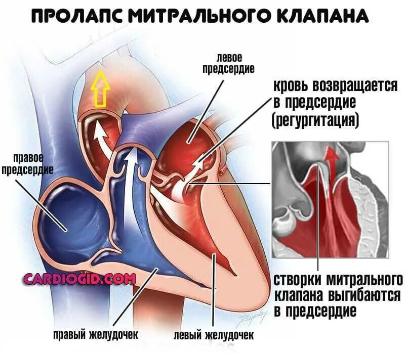 Что такое пролапс митрального клапана. Пролапс митрального клапана 1 степени. Пролапс центрального клапана сердца 1 степени. Провисание створок митрального клапана. Пролапс створки митрального клапана.