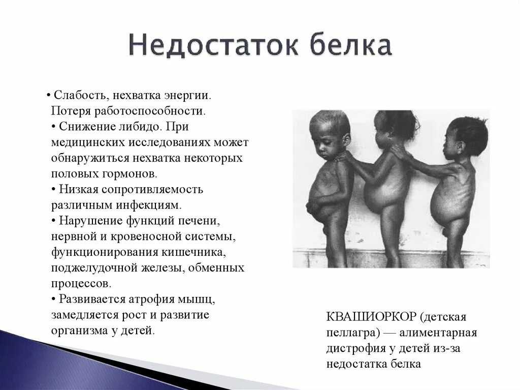 Белковый дефицит. Недостаток белков в организме. Белковый дефицит. Недостаток белка. Недостаточность белков в питании.