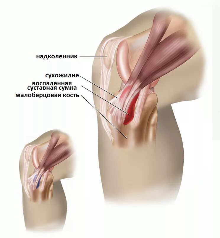 Мешочек в колене. Мешочек в колене. Мешочек в колене. Инфрапателлярный бурсит коленного. Препателлярный бурсит.