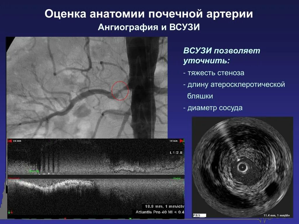 Атеросклероз на узи. Атеросклероз почечных артерий узи. всузи коронарных артерий. атеросклероз почечной артерии ангиография. узи при атеросклерозе почечной артерии.