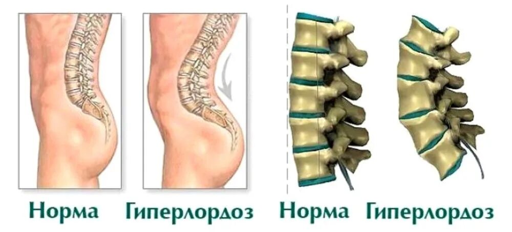 Как вылечить гиперлордоз