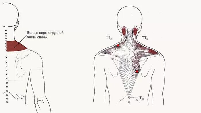 При вдохе болит левая сторона. Триггерные точки на спине схема лопатка. Триггерные точки боль мышцы спины. Мышцы шеи триггерные точки схема.