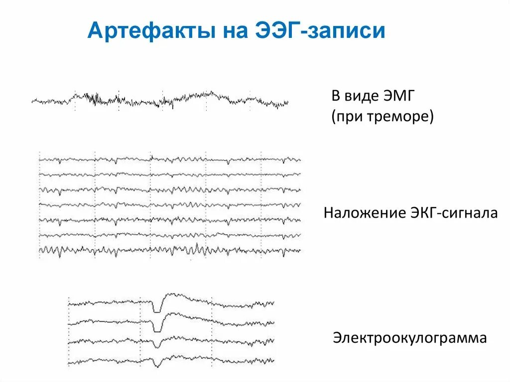 Артефакт ЭКГ на ЭЭГ. Физиологические артефакты ЭЭГ. Артефакт моргания на ЭЭГ. Двигательные артефакты на ЭЭГ. Запись на ээг