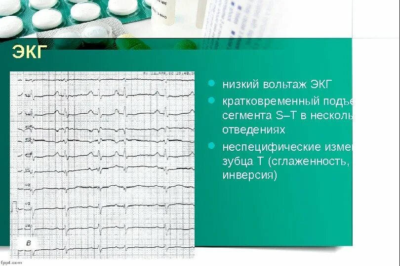 Низковольтажная ЭКГ причины. ЭКГ снижение вольтажа зубца r. Вольтаж QRS. Снижение вольтажа зубцов на ЭКГ. Низкоамплитудная экг что это значит