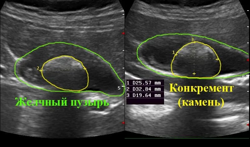 Узи полные органов. Конкременты желчного пузыря УЗИ. Камни в желчном пузыре УЗИ. Конкременты в желчном пузыре при ультразвуковом исследовании.