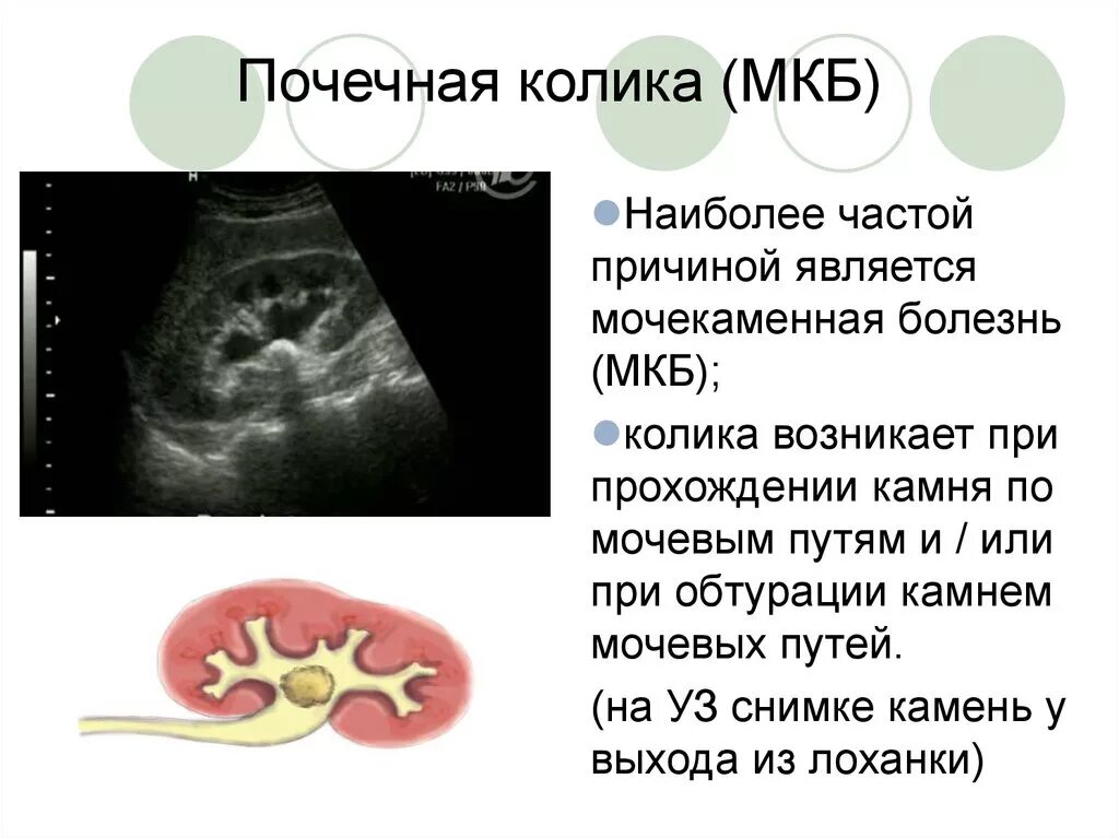 Мочекаменная болезнь почек мкб 10. Почечная колика мкб. Почечная колика мкб 10 мкб. Мочекаменная болезнь почечная колика