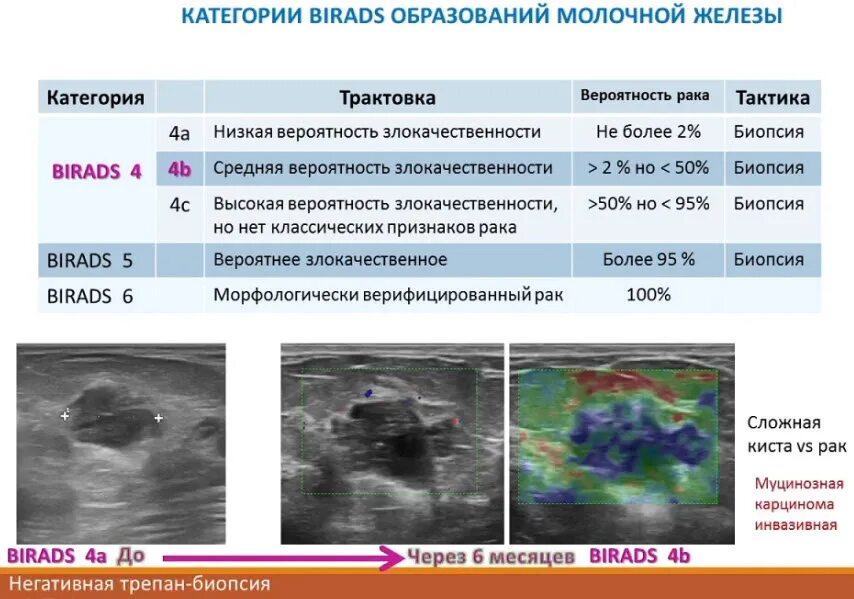 Классификация bi-rads молочных желез. Классификация кист молочной железы birads. Bi-rads 2 молочной железы что это. Категория bi rads 2 молочных желез