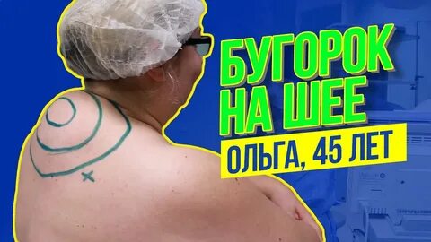 Вдовий горб липосакция отзывы