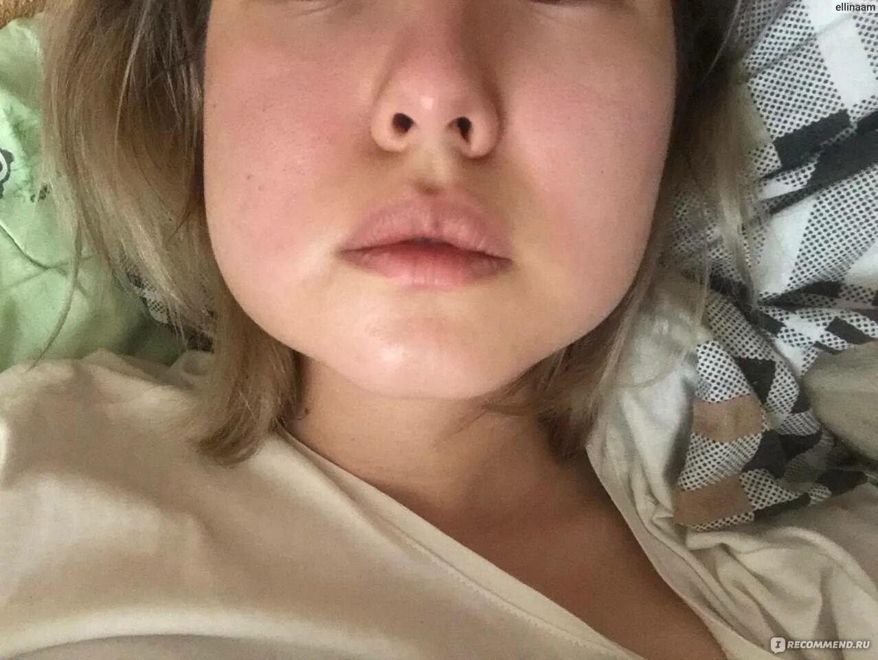 отек после вырывания зуба