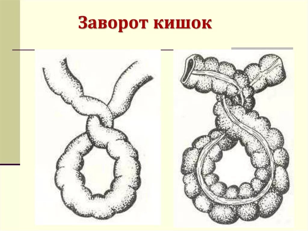 Расширение петель кишечника