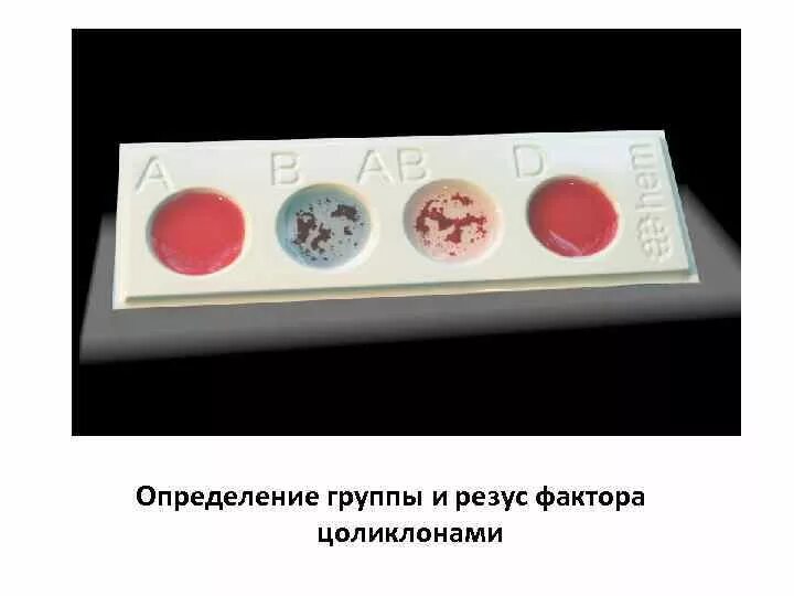 Определение резус фактора с помощью. Резус фактора цоликлонами.