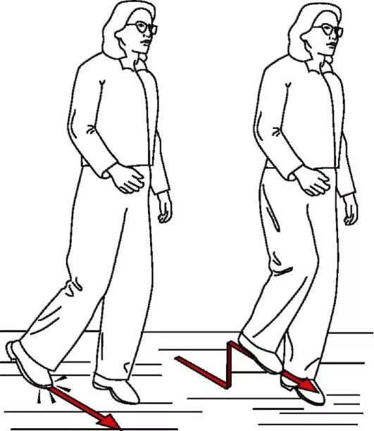 Походка степпаж. Походка степпаж неврология. Невропатия малоберцового нерва симптомы походка. Виды походок пропедевтика. Походка типа степпаж.