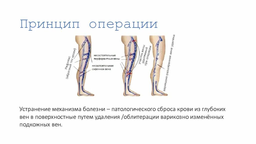 Операции при ВРВ нижних конечностей. ЭВЛК вен нижних конечностей. Перфорантные вены нижних конечностей. Перфорант вен нижних конечностей.