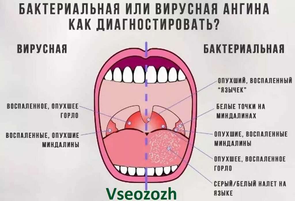 Как отличить вирус от бактериальной инфекции. Гнойная ангина лакунарная. бактериальная и вирусная ангина горло. вирусный и бактериальный тонзиллит. бактеририальная инфекция в норле.
