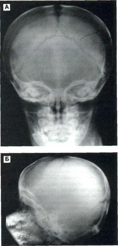 Вдавленный перелом лобной кости рентген. Оскольчатый перелом черепа рентген. Перелом теменной кости рентген. Перелом костей основания черепа рентген. Трещина черепа у ребенка