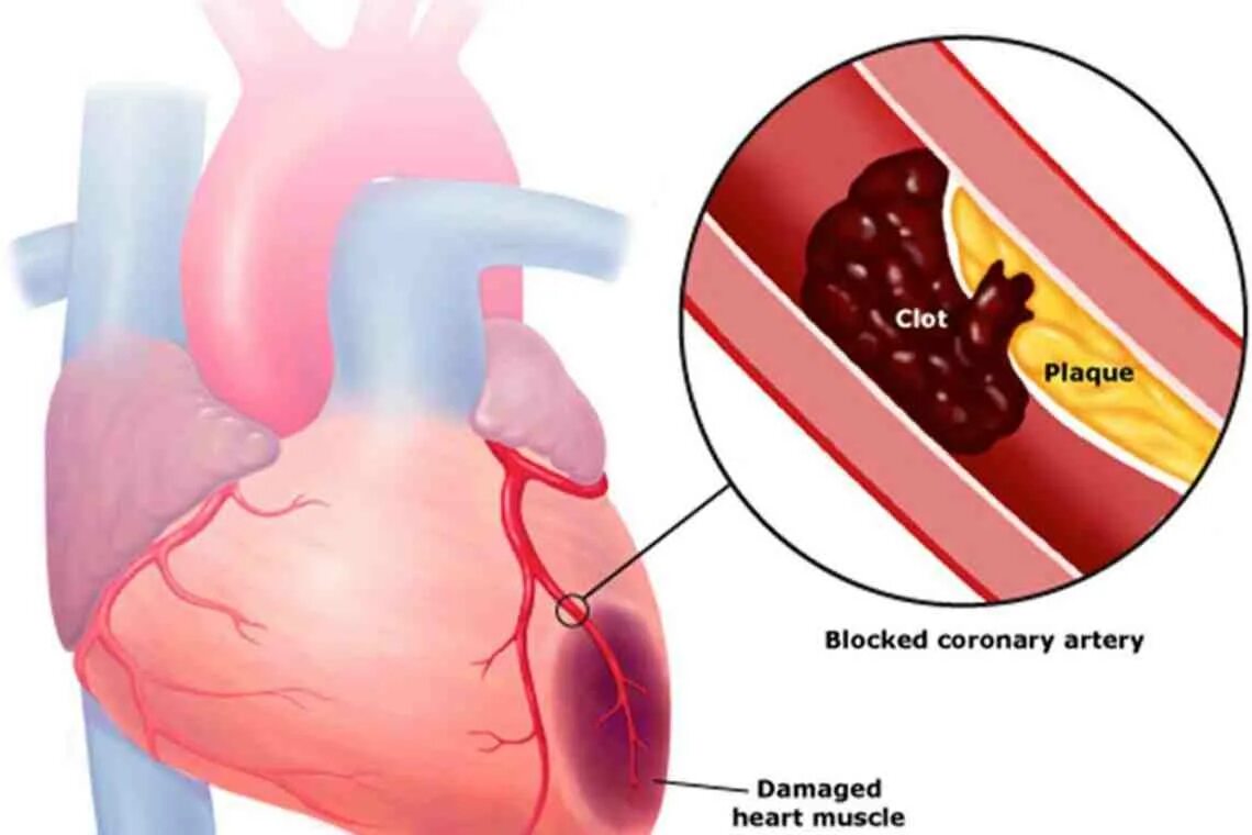 Тромбоз коронарных артерий. Инфаркт миокарда сердце. Тромбоз коронарной артерии.