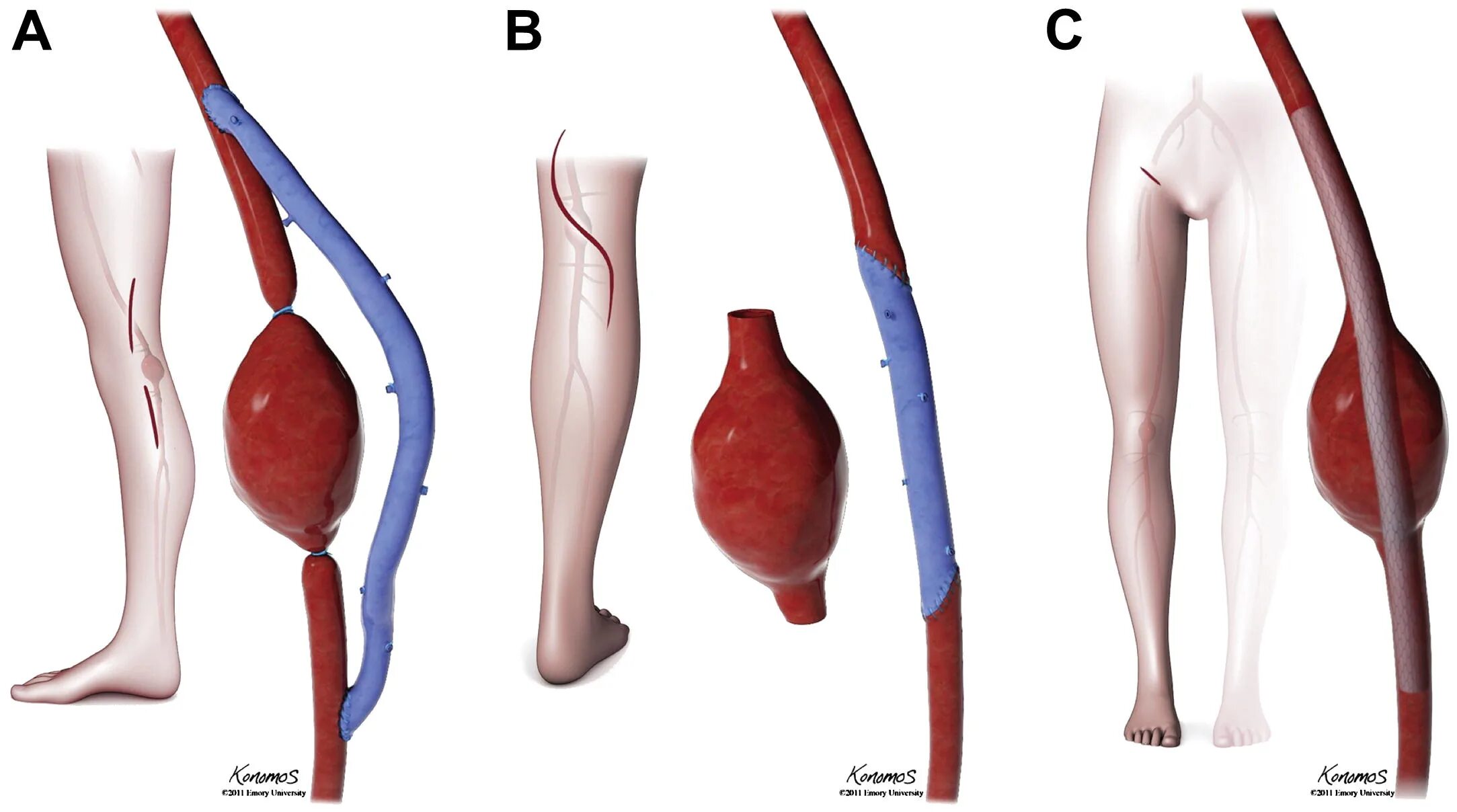Аневризма подколенной артерии. Аневризма нижних конечностей. Аневризма бедренной артерии.