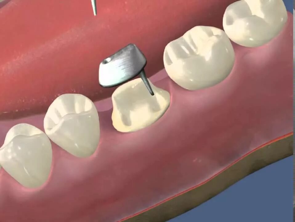 Почему ставят коронки. Штифтовая культевая вкладка. Промывная зона мостовидного протеза. Стекловолоконный штифт билдап. Внутрикорневая разборная вкладка.