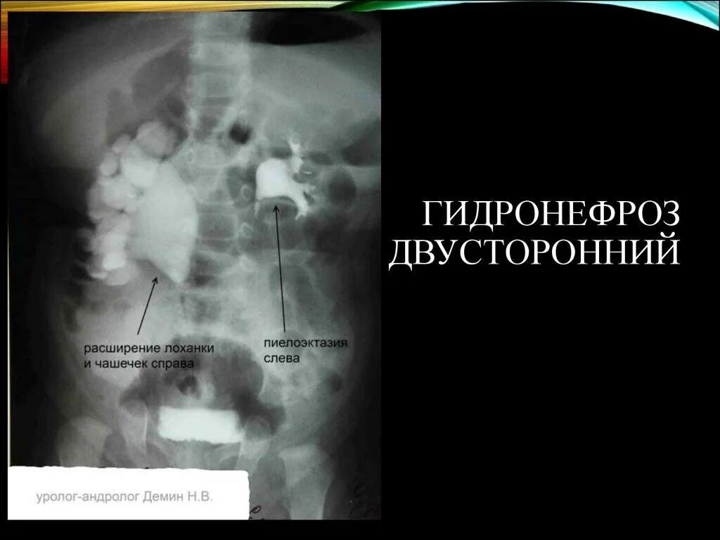 Гидронефроз что это и как лечить. Врожденный гидронефроз почки. калькулезный гидронефроз уретерогидронефроз. двусторонний гидронефроз почек рентген. гидронефроз рентгенодиагностика.