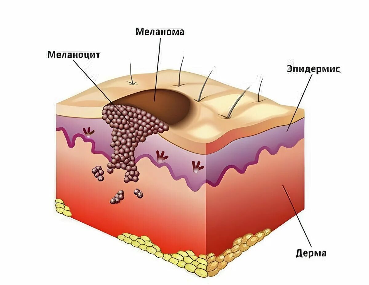 Распад кожи. Меланома строение кожи. Меланоциты эпидермиса кожи.