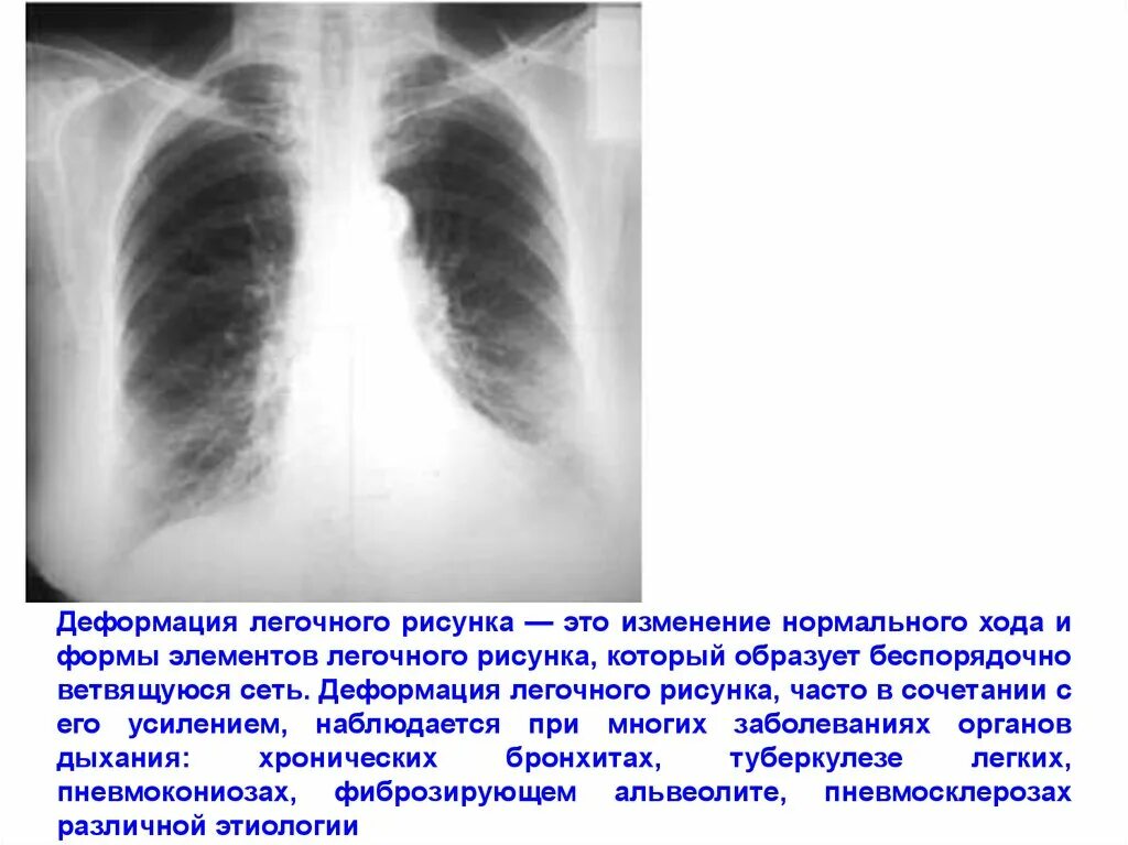 Усиленный в базальных отделах. Ячеистая деформация легочного рисунка рентген. Синусы ОГК рентген. Рентген легких усиление легочного рисунка. Усиление деформация легкого рентген.