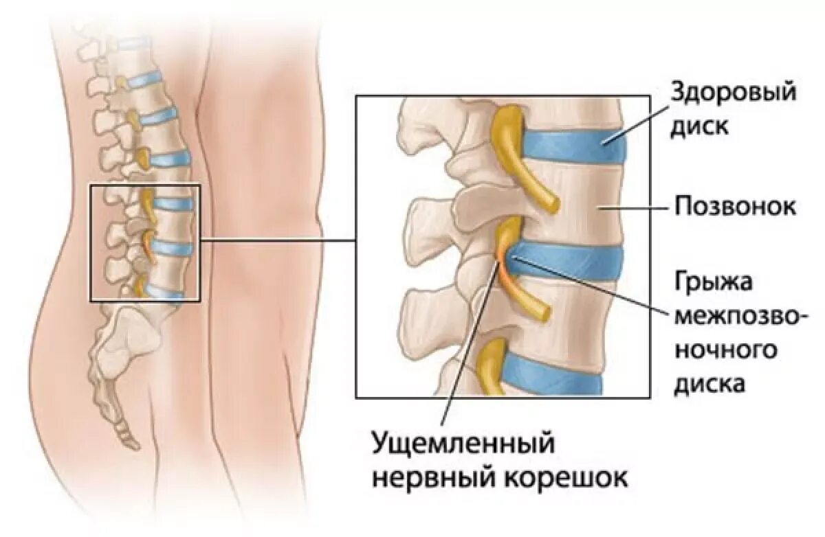 Межпозвоночная грыжа грыжа поясничного отдела. Грыжа позвонка поясничного отдела. Грыжа позвоночника защемление нерва. Межпозвоночные диски пояснично крестцового отдела. Можно ли греть грыжу позвоночника