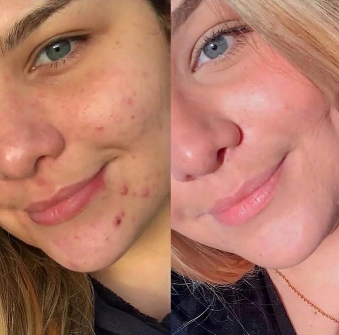 Косметический пилинг prx. Prx пилинг эффект. Пилинг prx-t33. Пилинг prx-t33 фото до и после. Prx-t33.