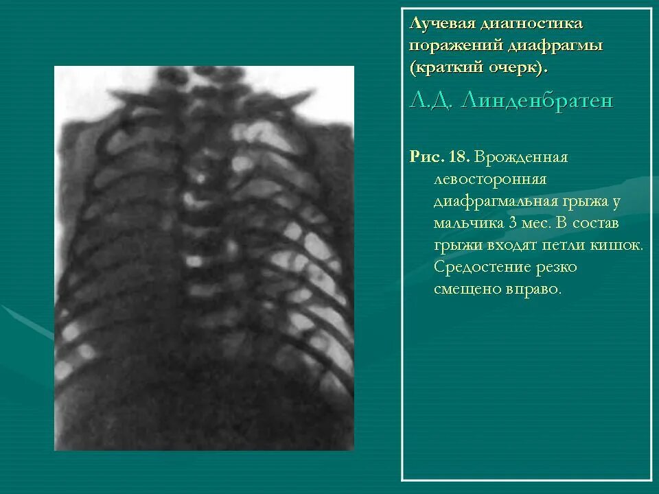 Релаксация купола диафрагмы что это такое. Высокое стояние диафрагмы. Релаксация купола диафрагмы. Врожденные аномалии диафрагмы. Врожденный парез диафрагмы.