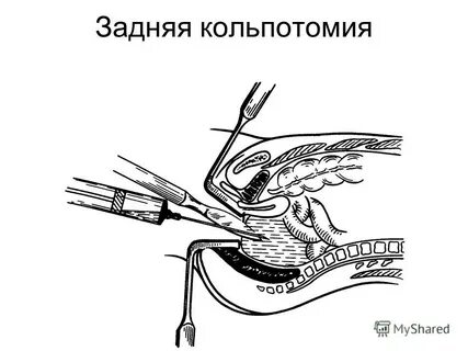 Кольпорафия отзывы форумы