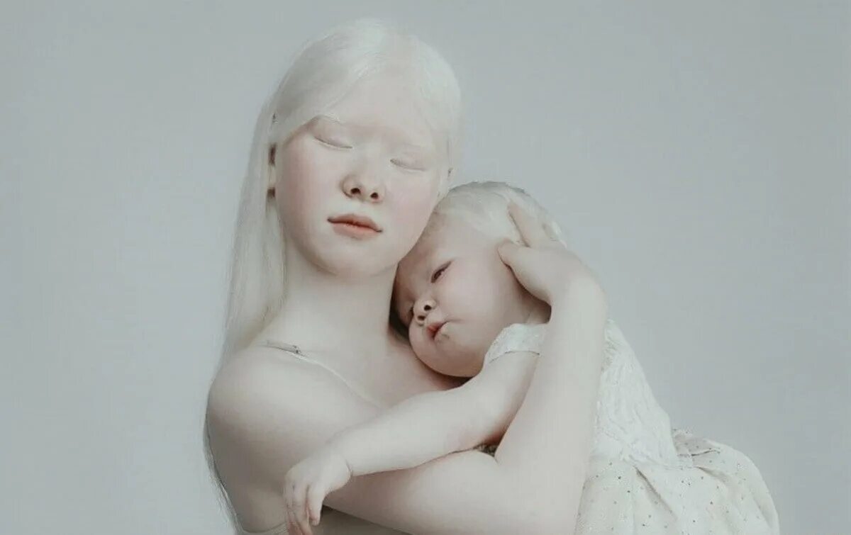 Страдающий альбинизмом. Сестры альбиносы из Актау.