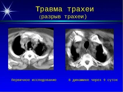 Кт трахеи