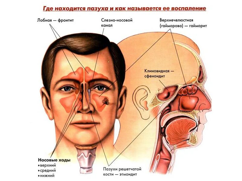 Хронический сфеноидит. Воспаление клиновидной пазухи. Клиновидная пазуха носа воспаление. Сфеноидит воспаление клиновидной пазухи. Воспаление основной пазухи.