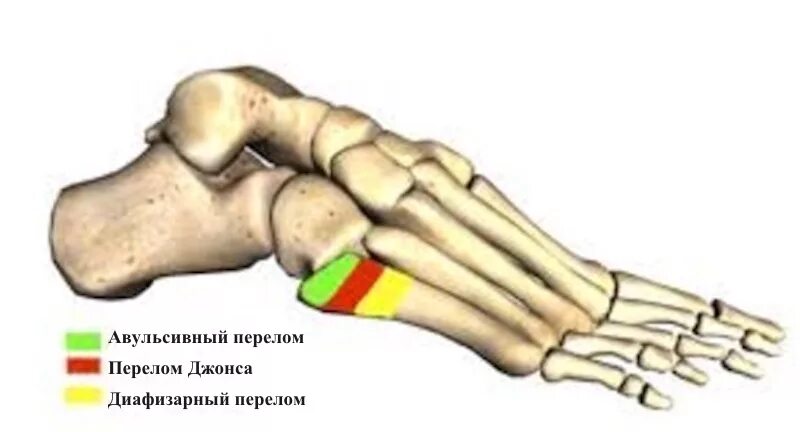 Трещина 5. Перелом Джонса 5 плюсневой кости. Перелом плюсневой кости 5 перелом Джонса. 5 Плюсневая кость стопы перелом.