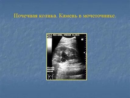 Почечная колика камни в почках