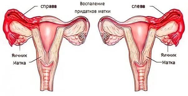 Болят ли придатки. Подострый правосторонний сальпингоофорит. Матка, маточная труба и яичник, придатки.. Хронический сальпингоофорит. Аднексит альгодисменорея.